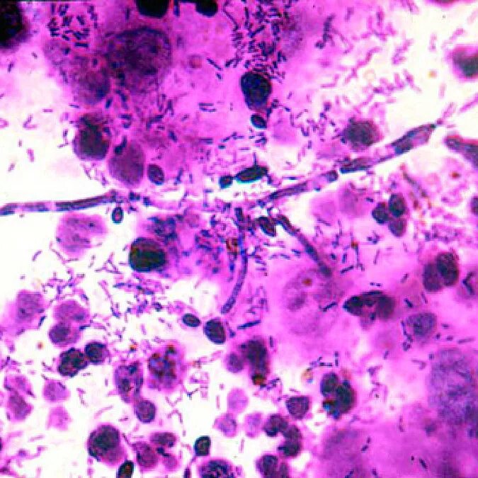 бактериальный вагиноз под микроскопом. фузобактерии микроскопия. коккобациллярная флора. трихомониаз микроскопия. коккобациллы.