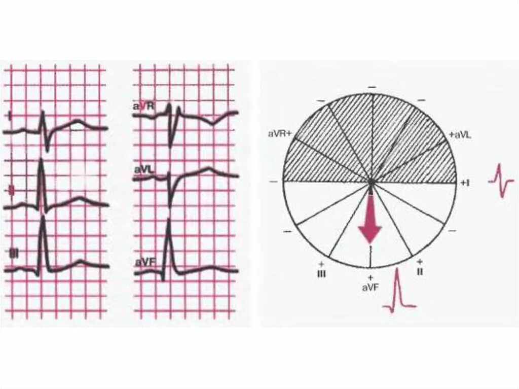 Вертикальная позиция сердца. Вертикальное расположение ЭОС на ЭКГ. Нормальное расположение ЭОС на ЭКГ. Вертикальная ось на ЭКГ. Электрическая ось сердца (ЭОС) на ЭКГ.