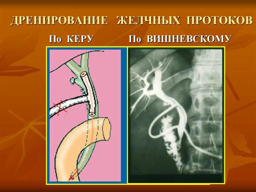 Наружно внутренний дренаж. Дренирование желчных протоков. дренирование желчных протоков по керу. дренирование желчного протока по керу. наружный дренаж холедоха.