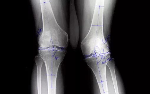Ревматоидный артрит коленного сустава рентген. Ювенильный ревматоидный артрит коленных суставов на рентгене. Ревматоидный артрит коленного сустава рентгенограмма. Вальгус коленных суставов рентген.