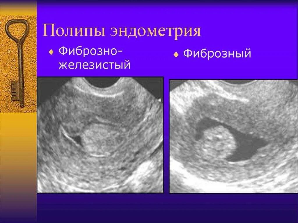 Полип эндометрия в матке причины. Железистый полип эндометрия на узи. гидросонография полипы. железистый полип эндотелия. пролиферирующий полип эндометрия что это.