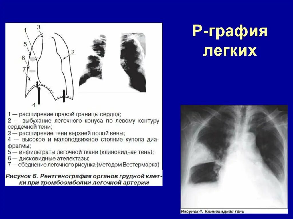 Дилатация правых отделов. Тромбоэмболия легочной артерии рентген. Эмболия легочной артерии рентген. Расширение легочной артерии рентген. R графия легких.