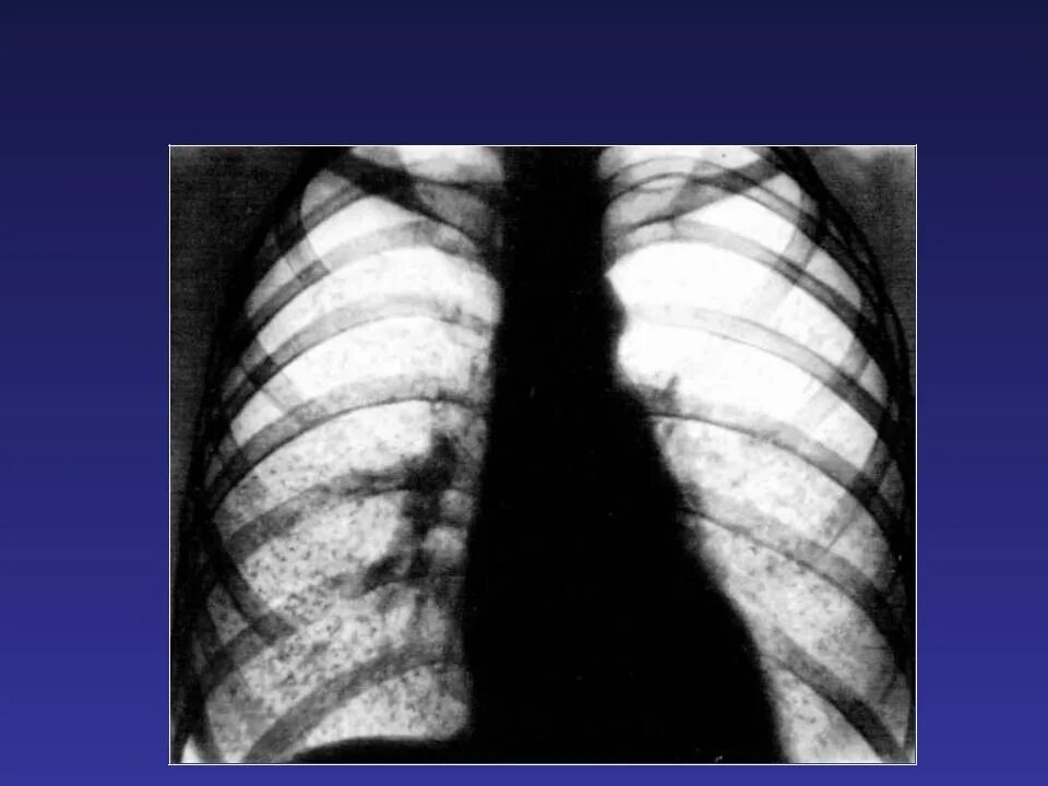 Острый диссеминированный туберкулез. Милиарный диссеминированный туберкулез. Острый милиарный диссеминированный туберкулез. Острый диссеминированный туберкулез рентген. Гематогенно диссеминированный туберкулез рентген.