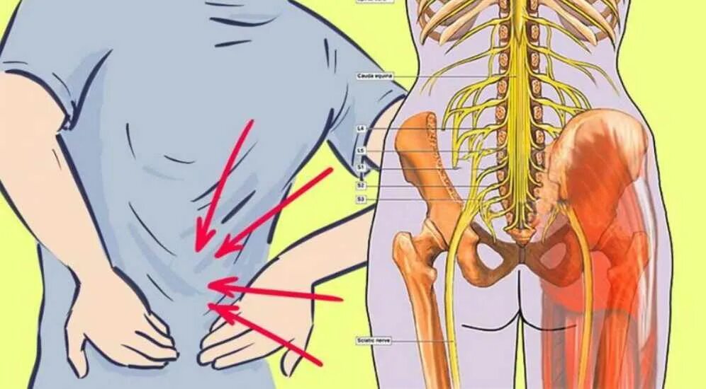 Блокада при защемлении седалищного. Седалищный нерв позвоночника. Болит спина. Невралгия седалищного нерва. Седалищный нерв схема.