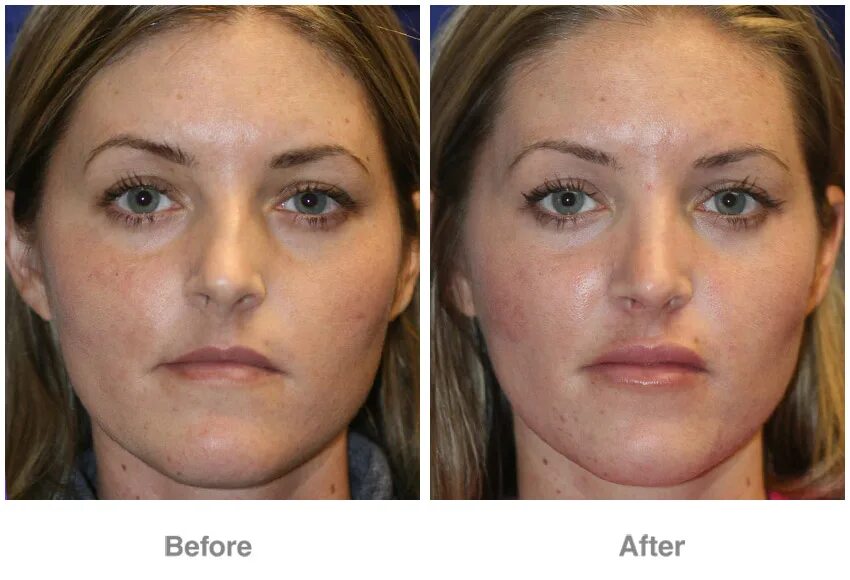 Липофилинг верхней губы. Липофилинг губ до и после. Липофилинг губ и носогубных складок. Липофилинг губ и носогубных складок. Липофилинг губ до и после.