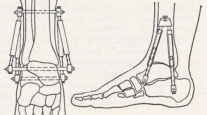 После артродеза голеностопного сустава. Артродез коленного аппарат Илизарова. Артродез голеностопного сустава аппаратом Илизарова. Операция артродез голеностопного сустава. Артродез коленного сустава.