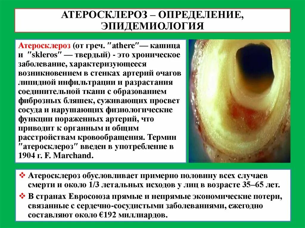 Атеросклероз что это за заболевание. Эпидемиология атеросклероза. атеросклероз определение. распространенность атеросклероза. атеросклероз и артериосклероз.