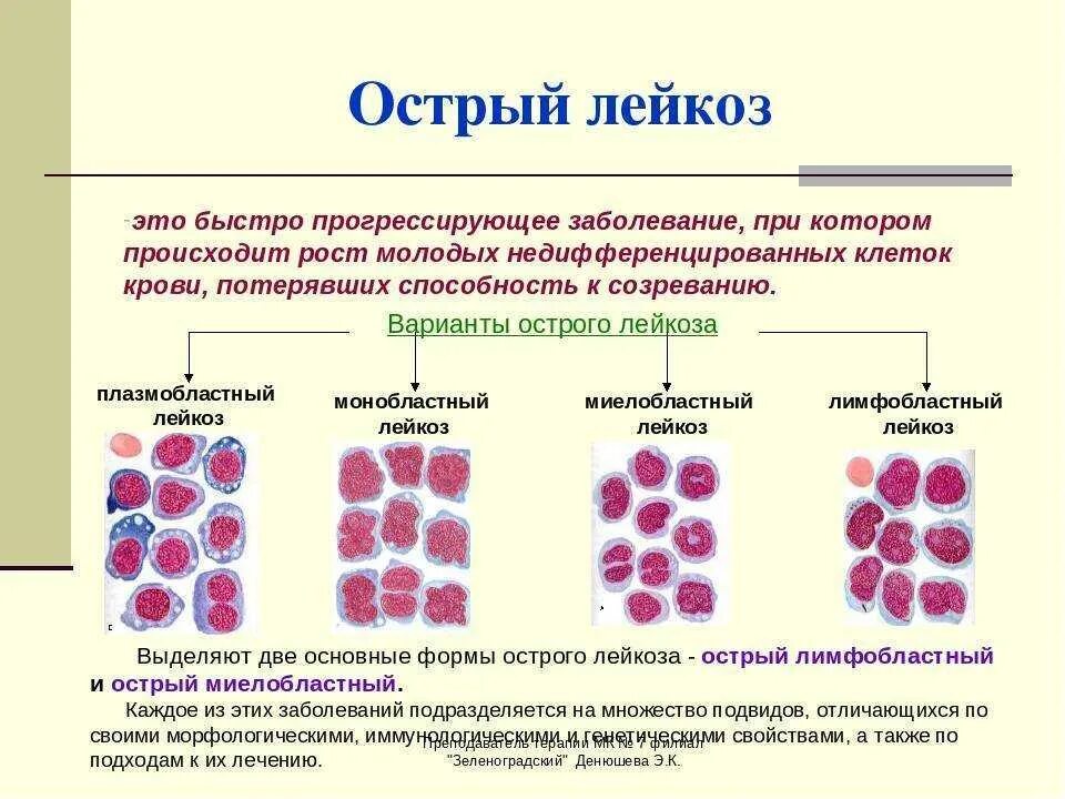 Недифференцируемый острый миелобластный лейкоз. Острый миелоидный и лимфобластный лейкоз. Острый лимфобластный лейкоз морфология. Острый лейкоз классификация картина крови. Опухоль клеток крови