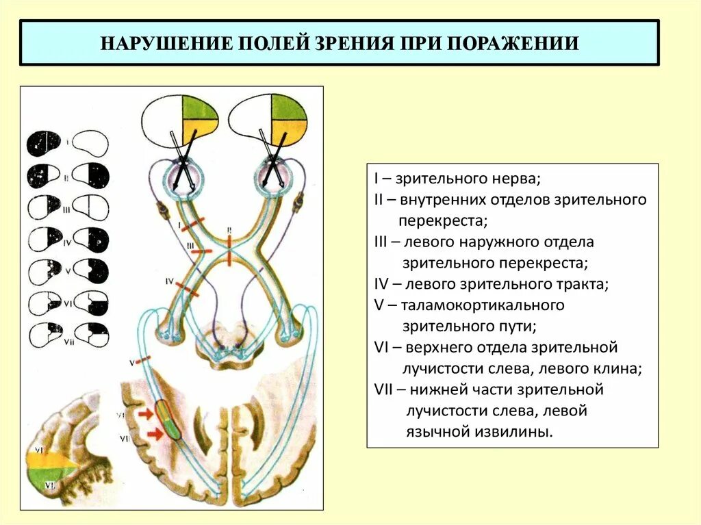 Поля зрения патология. Нарушение полей зрения неврология. Поражение хиазмы зрительного нерва. Выпадение полей зрения.