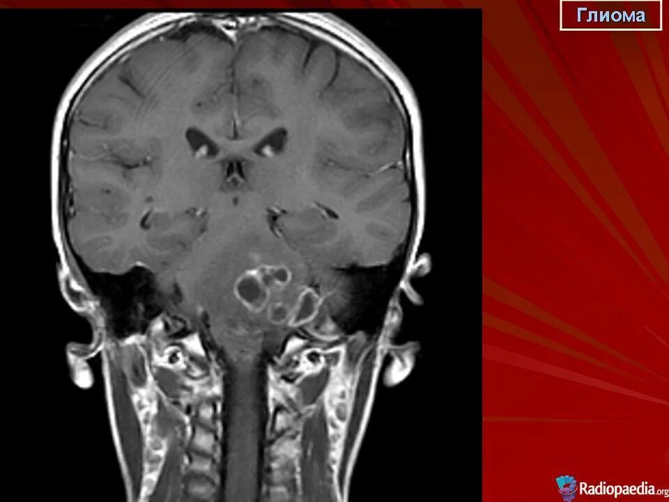 Глиома у детей. Глиома ствола головного мозга мрт. Глиома ствола головного мозга симптомы. Диффузная глиома моста головного мозга.