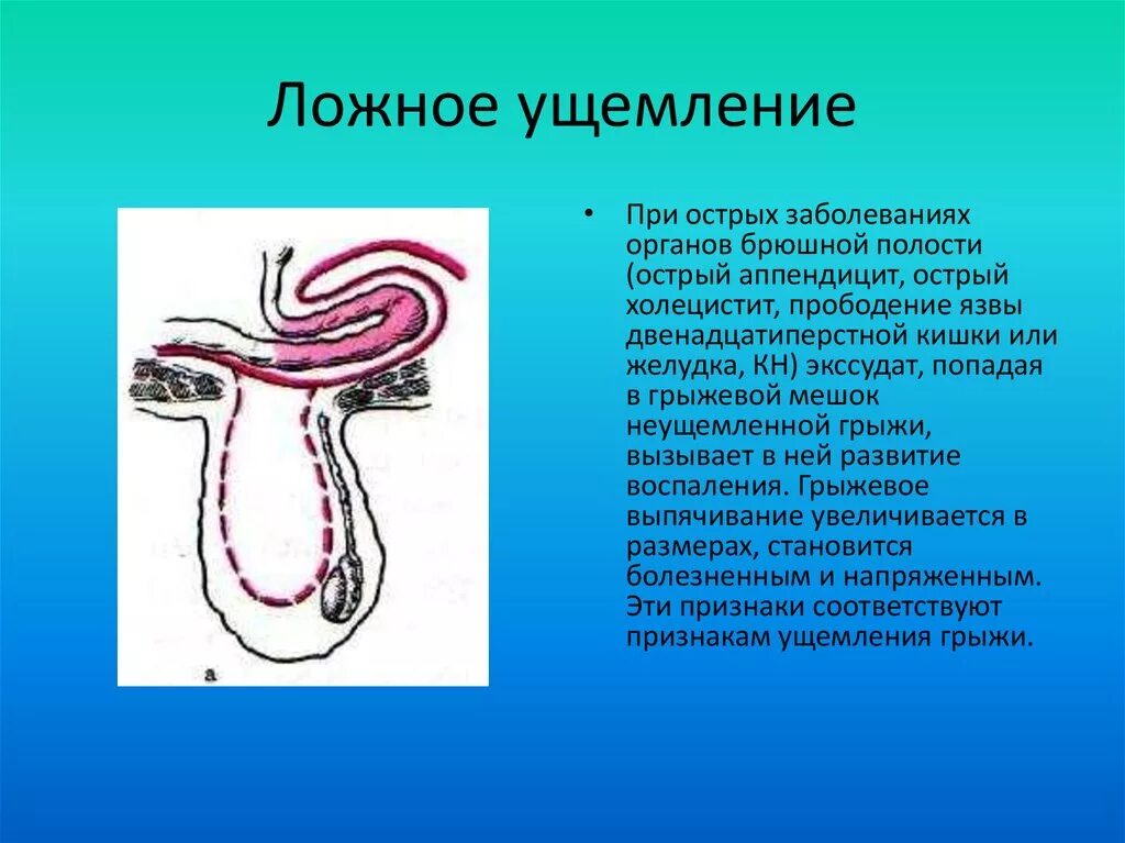 Ложное ущемление грыжа Брока. Ложное вправление ущемленной грыжи. Мнимое вправление ущемленной грыжи. Мнимое ложное ущемление грыжи.