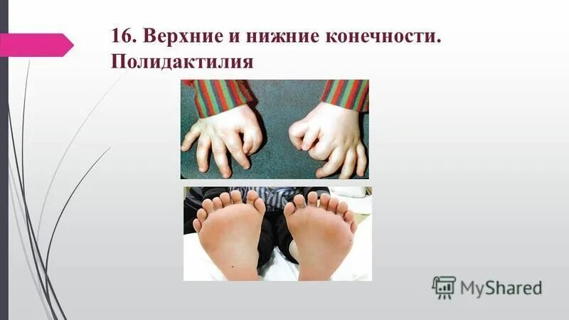 катаракта и полидактилия вызываются доминантными