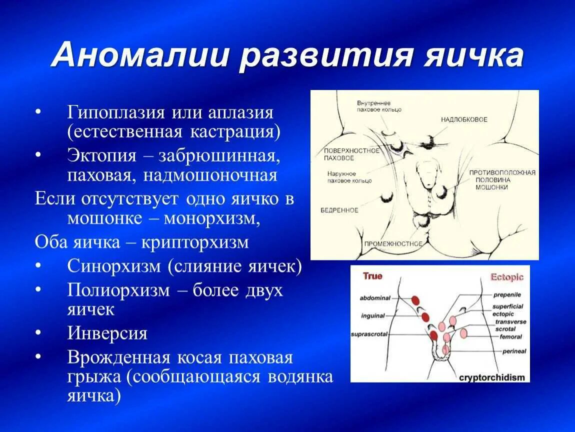 Аномалии положения яичка.