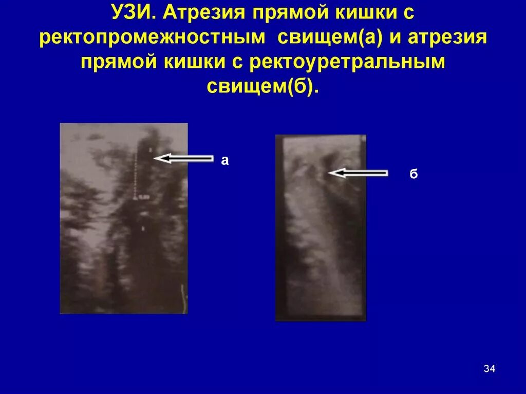 Пороки развития прямой кишки классификация. Атрезия ануса у плода на УЗИ. Атрезия прямой кишки УЗИ. Пороки развития прямой кишки у детей. Стеноз прямой