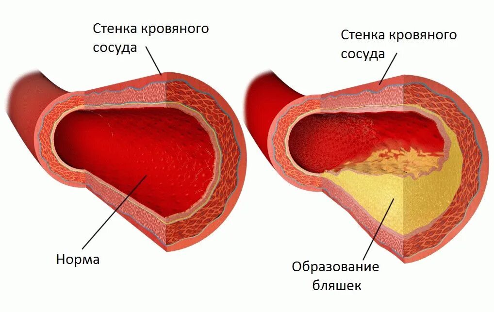 Изменение сосудистой стенки. Холестериновые бляшки в сосудах. Атеросклероз бляшки сосудов. Атеросклероз холестериновая бляшка. Атеросклероз (закупорка кровеносных сосудов).