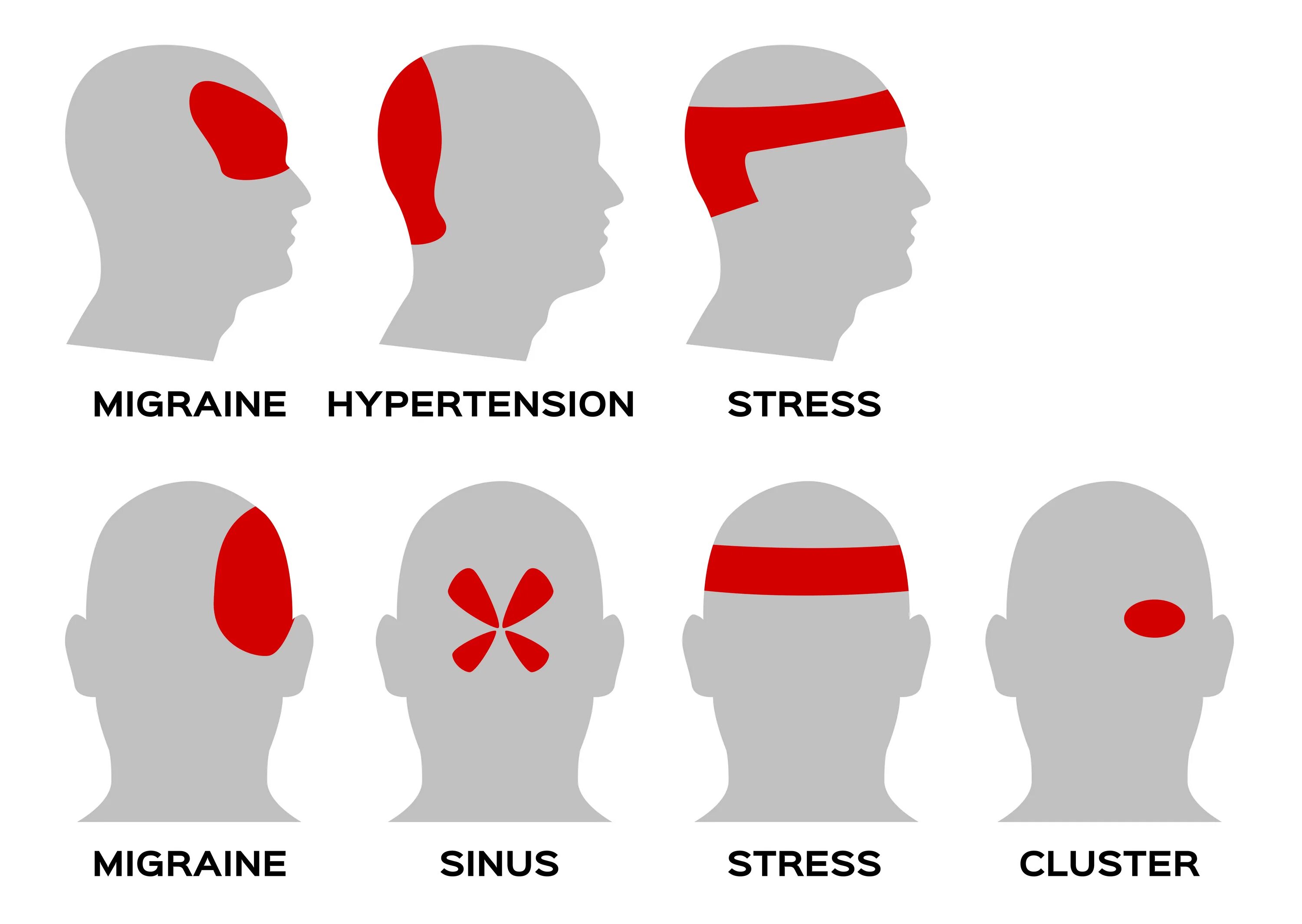 Виды головной. Зоны боли головы. Локализация боли в голове. Зоны головных болей головы. Головная боль схема.