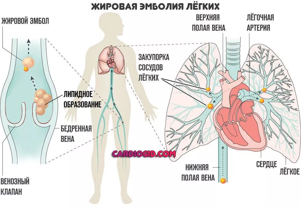 Тромболегочная эмболия