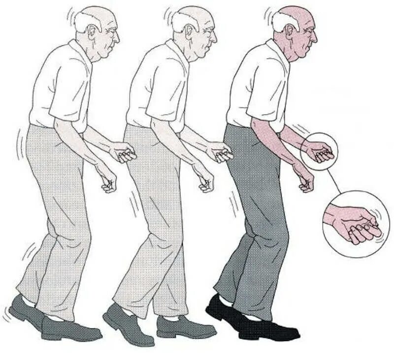 Паркинсона акинетико ригидная. Паркинсонизм походка. Походка при болезни Паркинсона. Паркинсон болезнь Паркинсона.