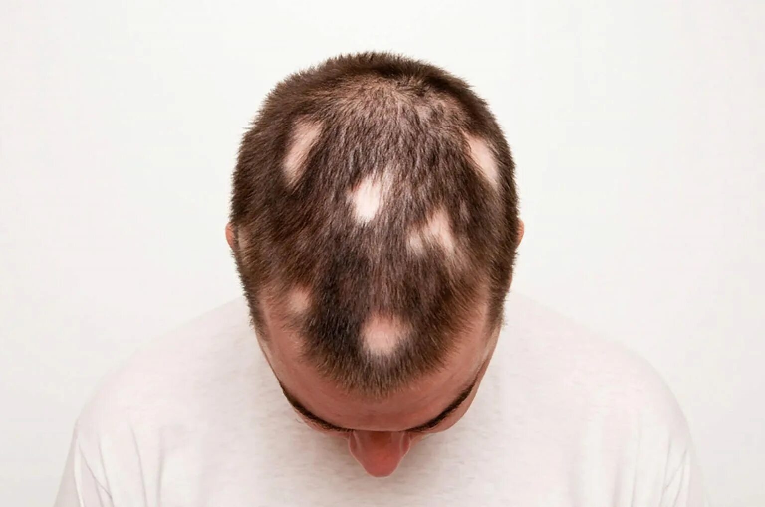 Очаговая алопеция (alopecia Areata). Очаговая (гнездная) алопеция. Андрогензависимая алопеция. После ковида выпадают волосы что делать