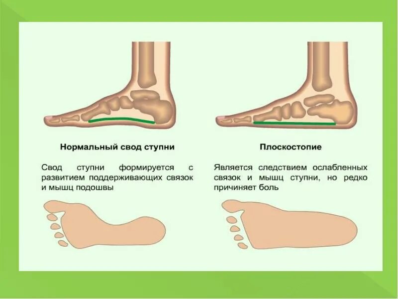 Нормальная стопа и плоскостопие у детей. Свод стопы при плоскостопии. Плоскостопие вид сбоку. Свод стопы при плоскостопии. Свод стопы при плоскостопии.
