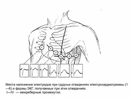 Наложение электродов при экг схема по цветам