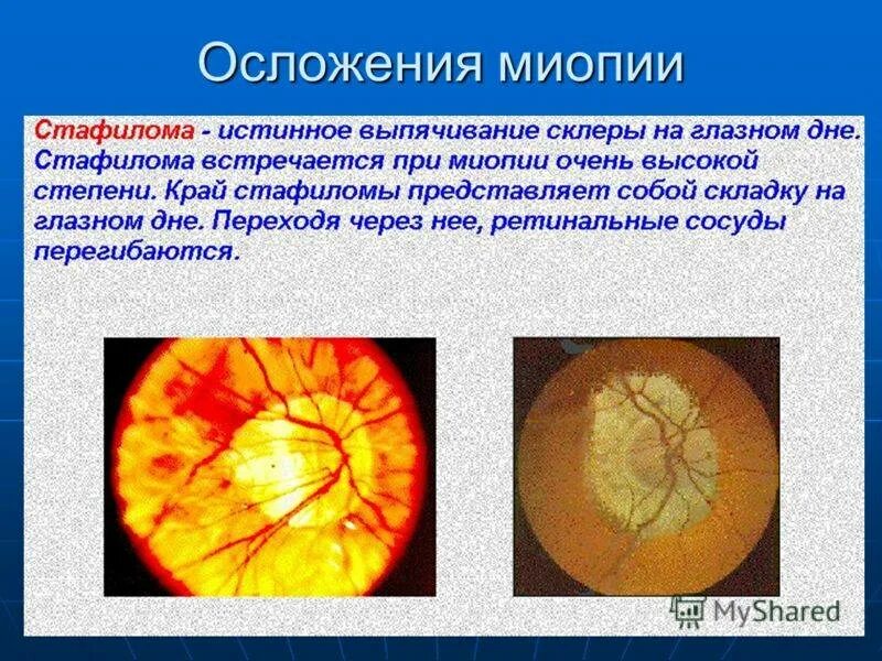 Миопическая стафилома сетчатки. Миопический конус глазное дно. Стафилома диска зрительного нерва.