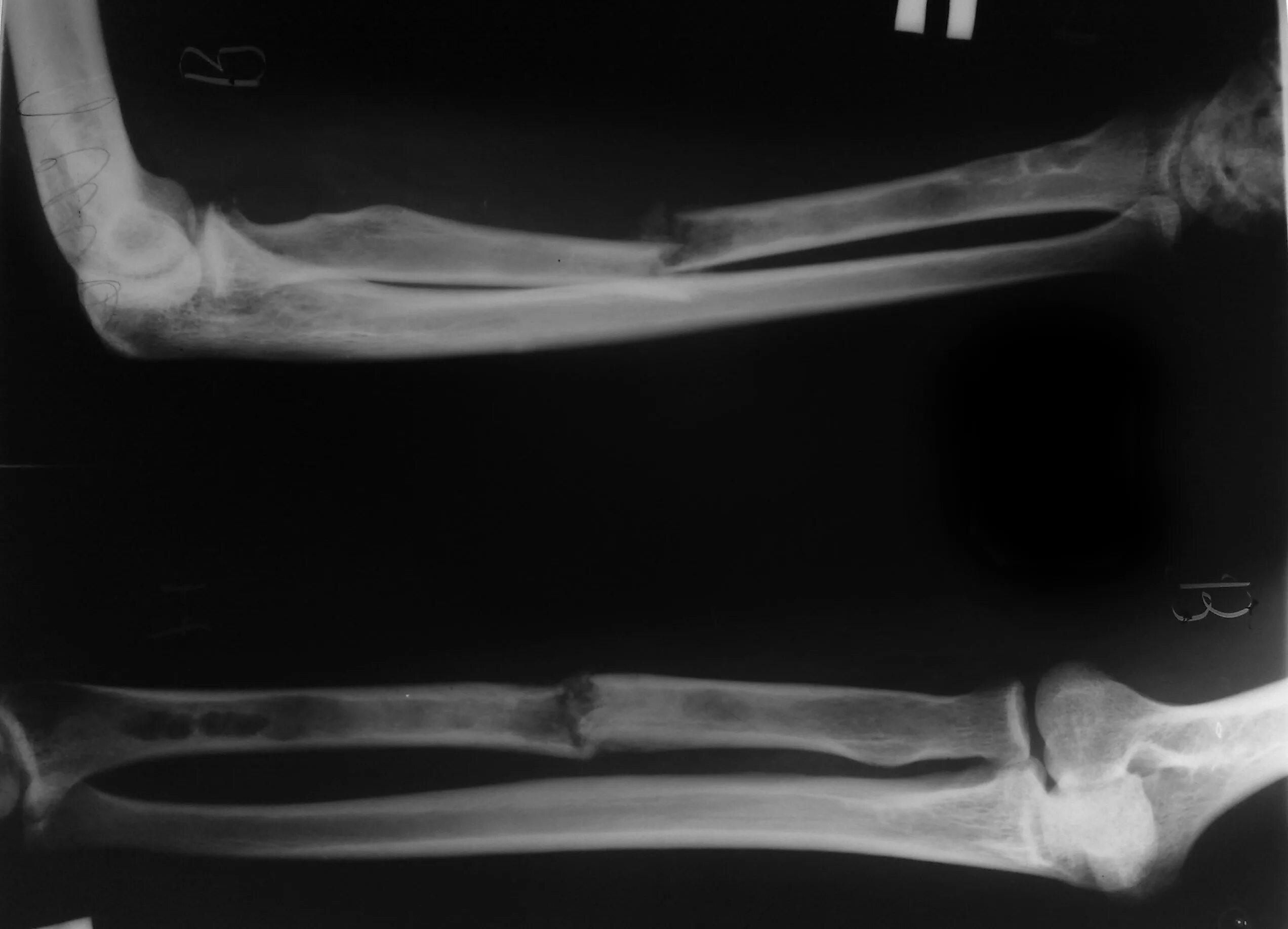 Лечение после переломов костей. Перелом лучевой кости рентген. Перелом диафиза лучевой кости. Срастание костей при переломе на рентгене. Перелом костей предплечья рентген.