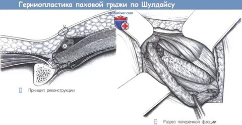 Паховая герниопластика
