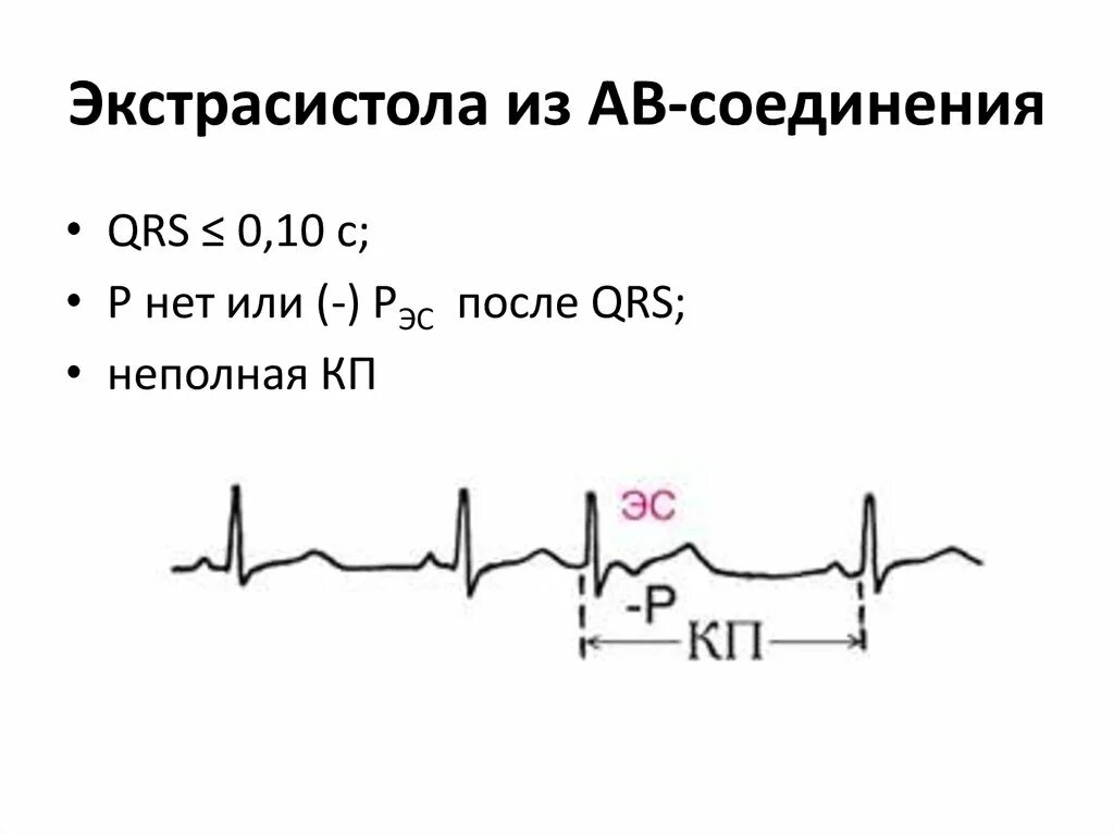 АВ Узловая экстрасистолия на ЭКГ. Экстрасистолия АВ соединения на ЭКГ. Av Узловая экстрасистолия на ЭКГ. Атриовентрикулярная экстрасистолия на ЭКГ. Блокада экстрасистолы