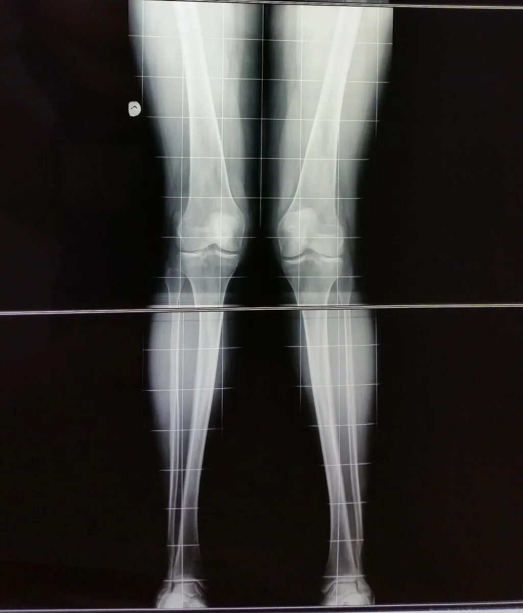 Рентген нижних конечностей. Панорамная рентгенограмма нижних конечностей. Рентгеновские снимки нижних конечностей.