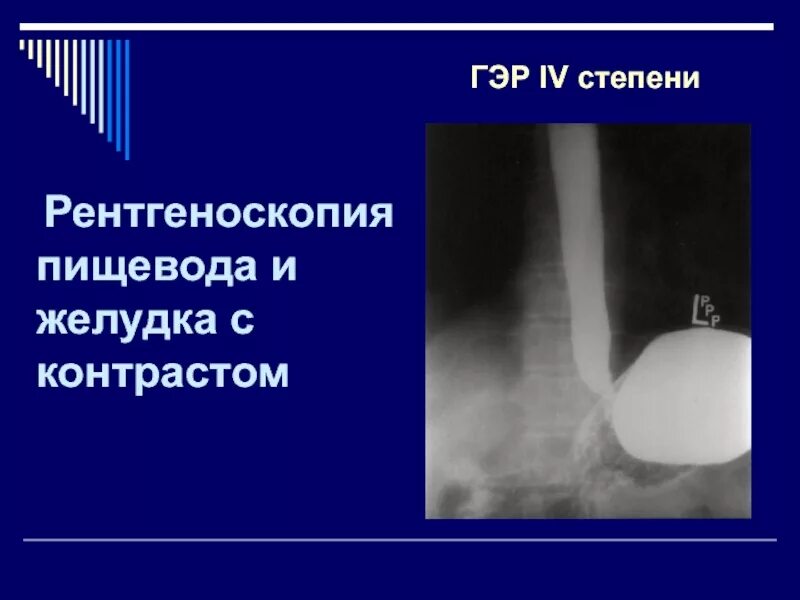 Пищевод у детей. Химический ожог пищевода. Стадии химического ожога пищевода. Химический ожог пищевода 1 степени. Химические ожоги пищевода у детей.