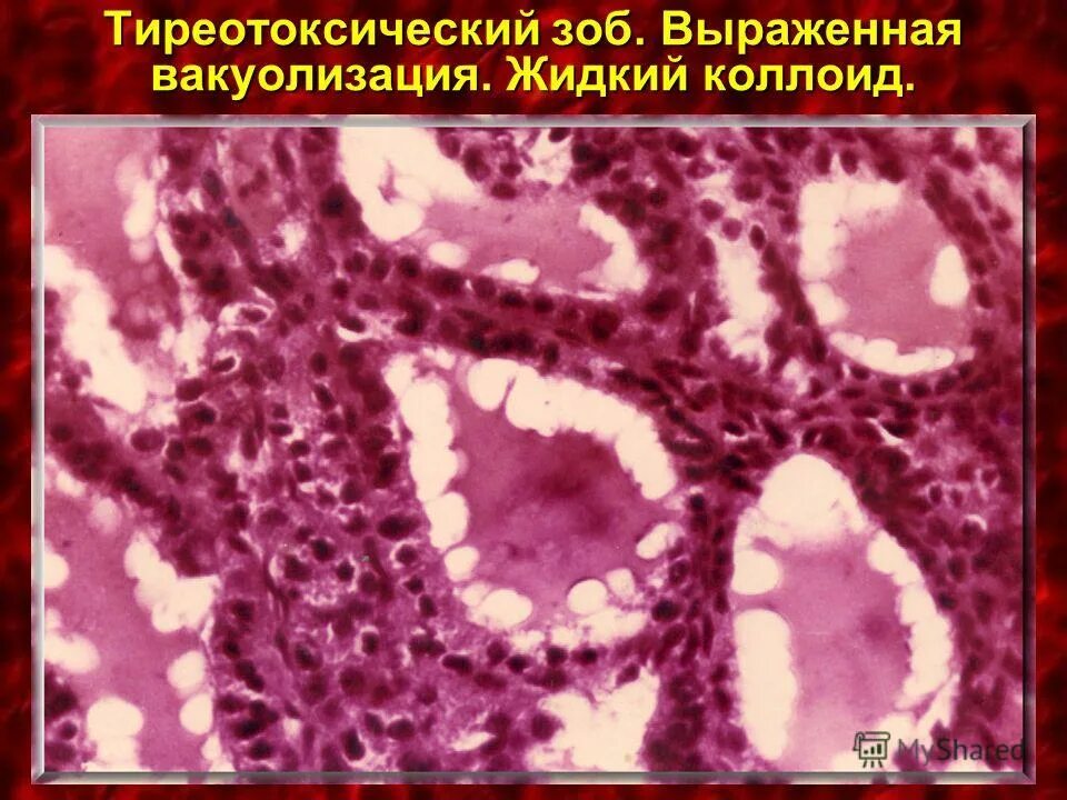 Тиреотоксический зоб гистология. Спорадический зоб гистология. Эндемический зоб гистология. Диффузный токсический зоб гистология.