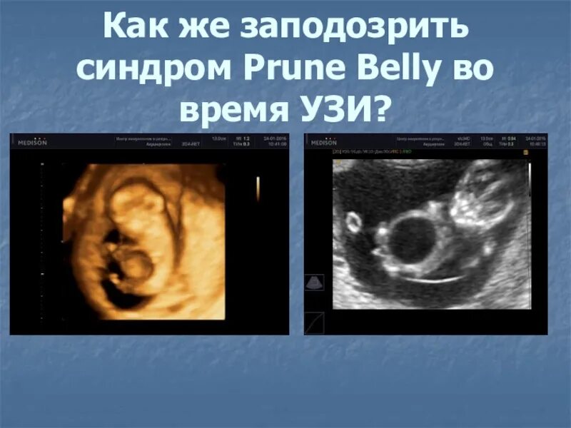 Ребенок исчез во время узи как называется. Синдром пруне-белли живот. узи беременных презентация.