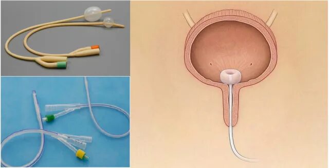 После удаления мочевого пузыря у мужчины. Цистостома мочевого пузыря катетер. Мочеприемник для катетера Фолея. Эпицистостомический катетер. Мочеотводной катетер.