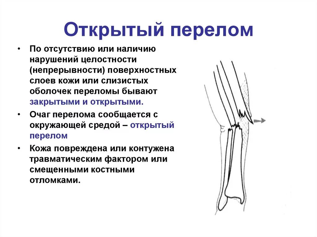 Открытая трещина. Открытый и закрытый перелом. Открытый перелом перелом. Схема открытого перелома.