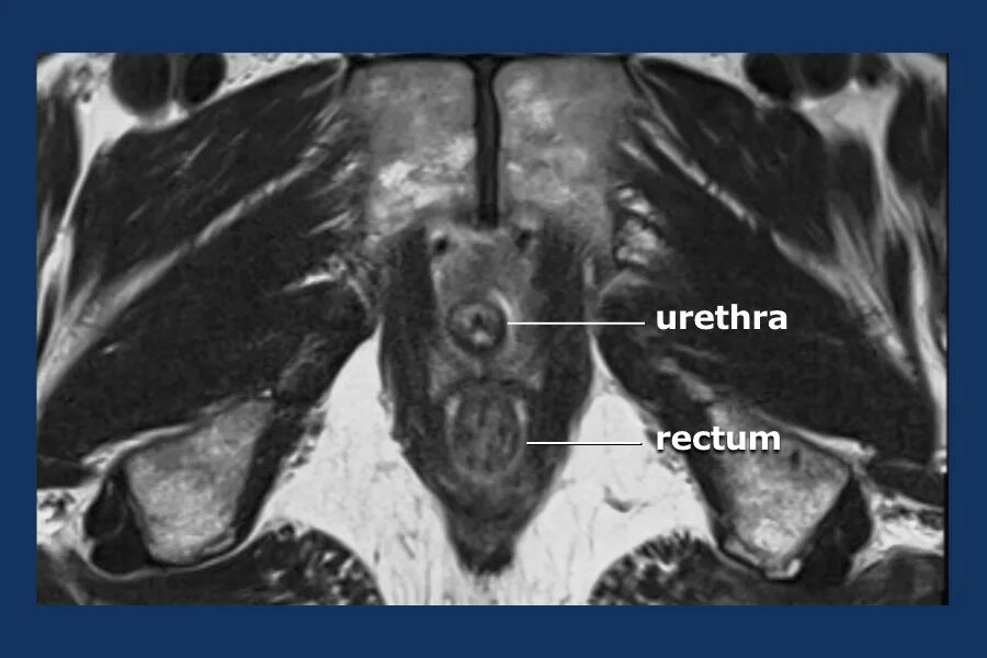 Анатомия предстательной железы мрт. Аденокарцинома предстательной железы мрт. Гиперплазия предстательной железы мрт. Pirads мрт предстательной железы. Уретра предстательной железы