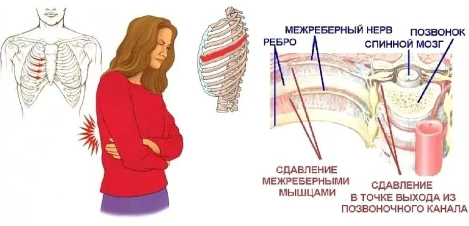 Неврология межреберная симптомы. Меж ребренная невралгия. Меж рёберная неврология. Межребкрная нкврвогия.