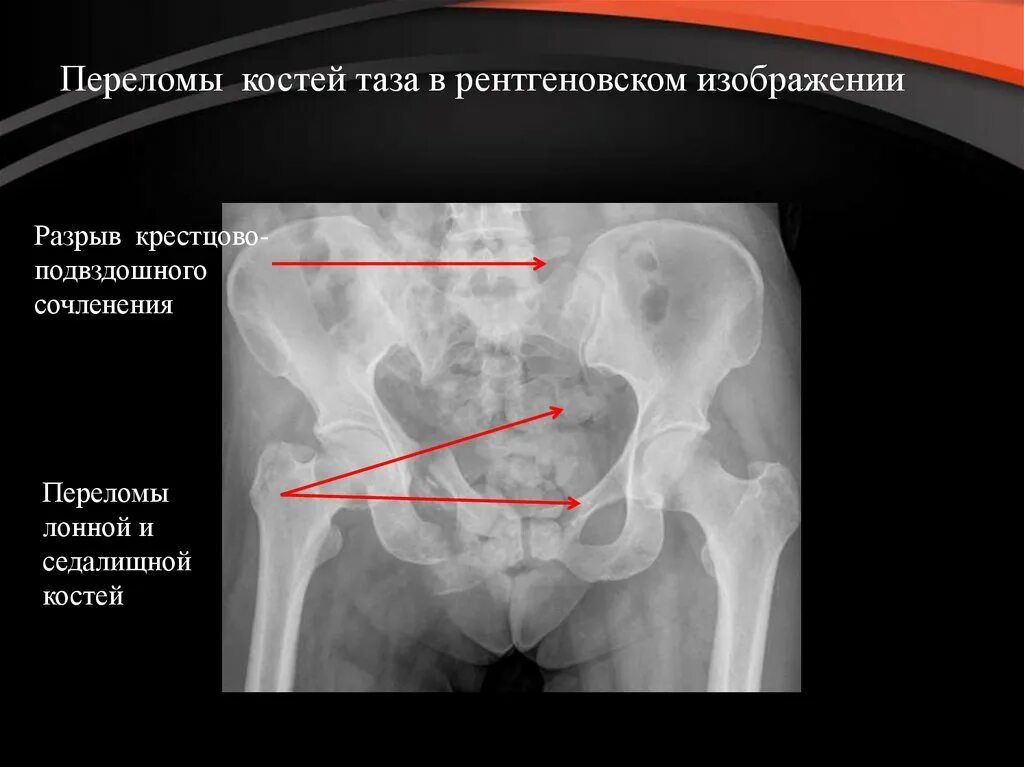 Перелом седалищной и лонной кости рентген. Перелом лобковой кости таза рентген. Перелом крестца и лонной кости. Перелом нижней ветви левой лонной кости.