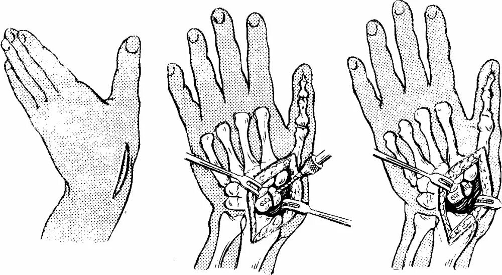 Ладьевидная кость кисти перелом. Перелом ладьевидной кости операция. Остеосинтез при переломе ладьевидной кости. Ладьевидная кость руки перелом. Операция на большом пальце руки