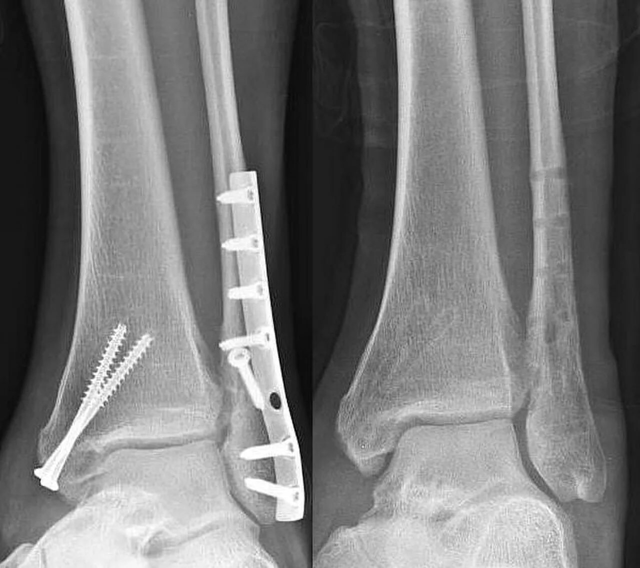 Погружной чрескостный остеосинтез. Экстрамедуллярный остеосинтез. Чрескостный остеосинтез рентгенограмма. Интермедулярный остеосинтез. Остеосинтез операция пластины