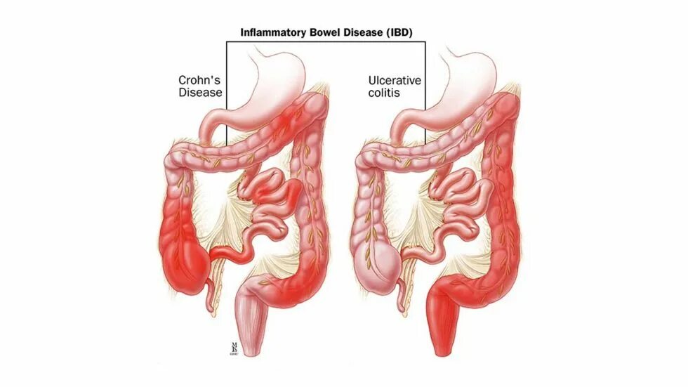 Язвенный колит толстой кишки. Что такое язвенный колит Толстого кишечника. Неспецифический язвенный колит слизистая. Болезнь крона поражение толстой кишки. Колит спросить врача