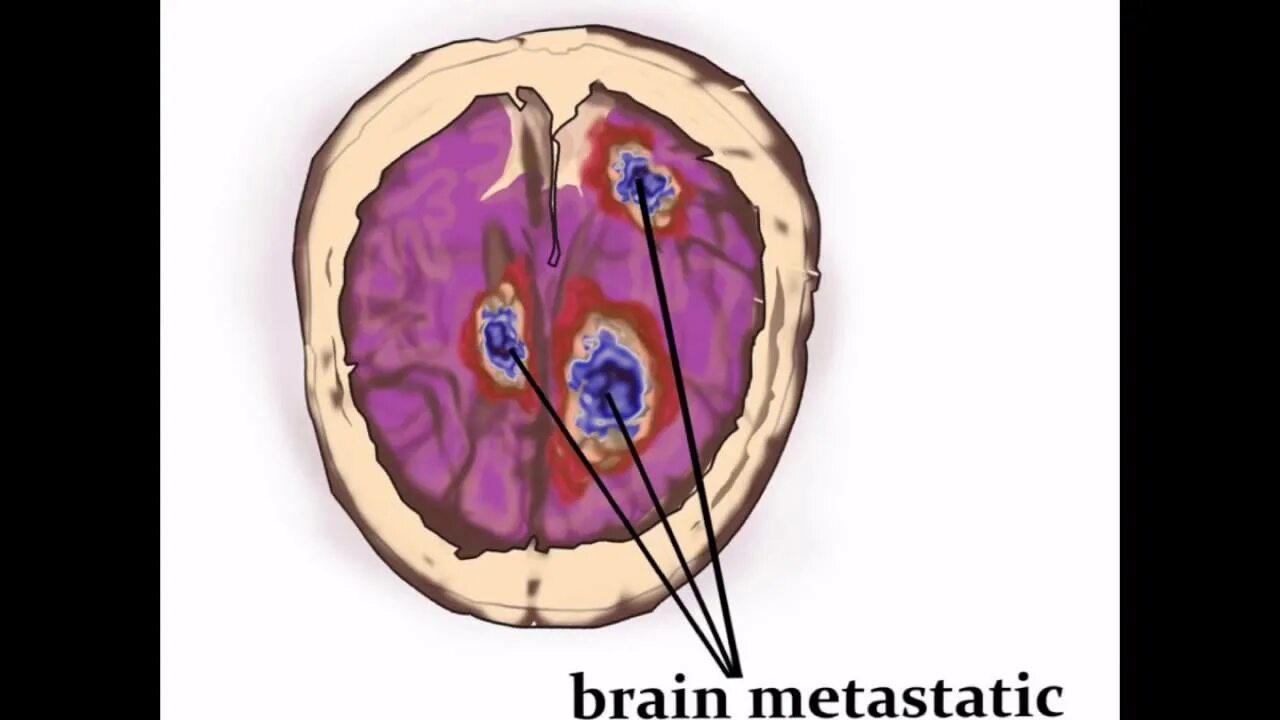 Меланома метастазы в мозг. Метастазы в головном мозге. Метастазированием в головной мозг. Метастатические опухоли головного мозга.