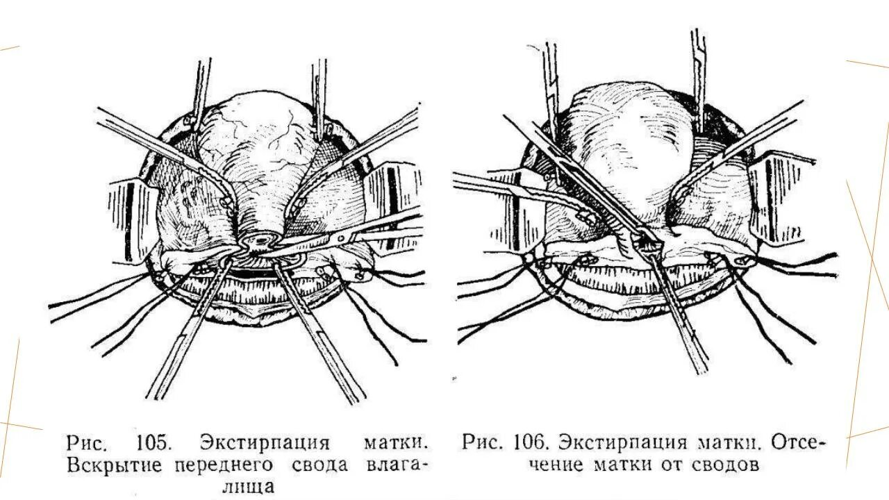 Лапаротомическая экстирпация матки. Ампутация и экстирпация матки. Гистерэктомия абдоминальная и влагалищная. Надвлагалищной ампутации матки.