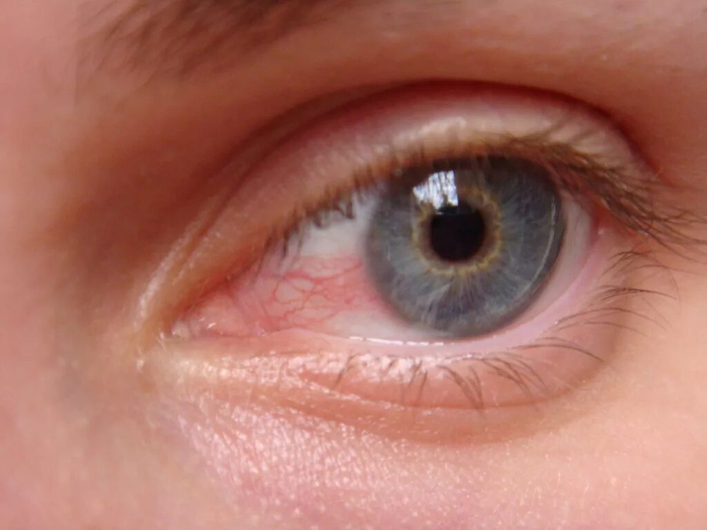 Почему глаза розовые. Авитаминозный кератит. Конъюнктивит герпетический кератит.