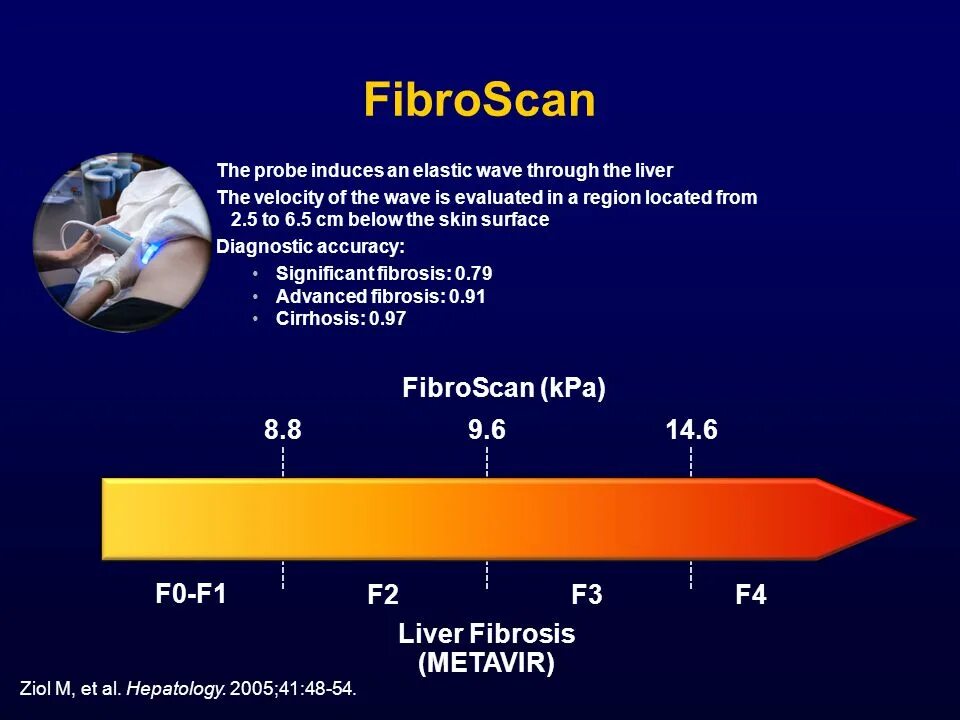 Лечение фиброза у мужчин. Эластография печени шкала metavir. Шкала metavir фиброскан. Эластометрия шкала метавир. Метавир классификация фиброза.