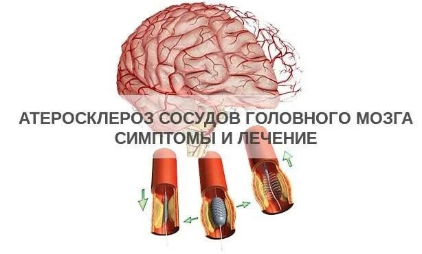 Атеросклероз церебральных сосудов симптомы. Атеросклероз артерий головного мозга. Симптомы при атеросклерозе артерий головного мозга. Атеросклероз сосудов мозга. Атеросклероз сосудов головного мозга симптомы.