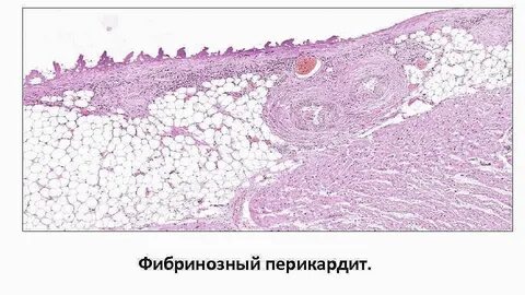 Фиброзное воспаление