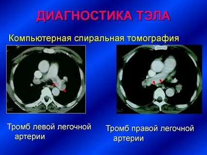 Тромб реанимация