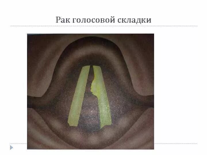 Как выглядит рак голосовых связок Удаление кисты во рту,операции лор органов в Москве метро Дмитровская, Тимиряз