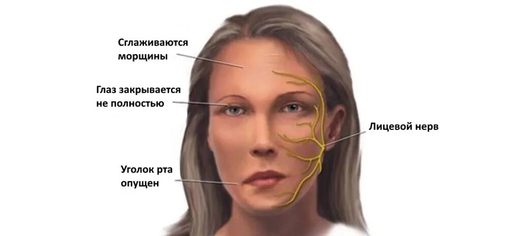 Массаж при параличе лицевого нерва. Неврит левого лицевого нерва. Невропатия лицевого нерва парез мимической мускулатуры. Лечение лицевой невропатии